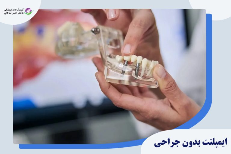 ایمپلنت بدون جراحی