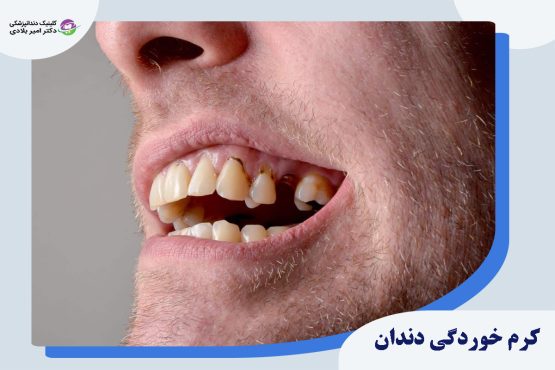 کرم ‌خوردگی دندان