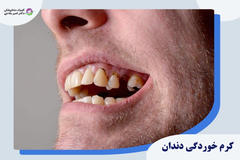 کرم ‌خوردگی دندان